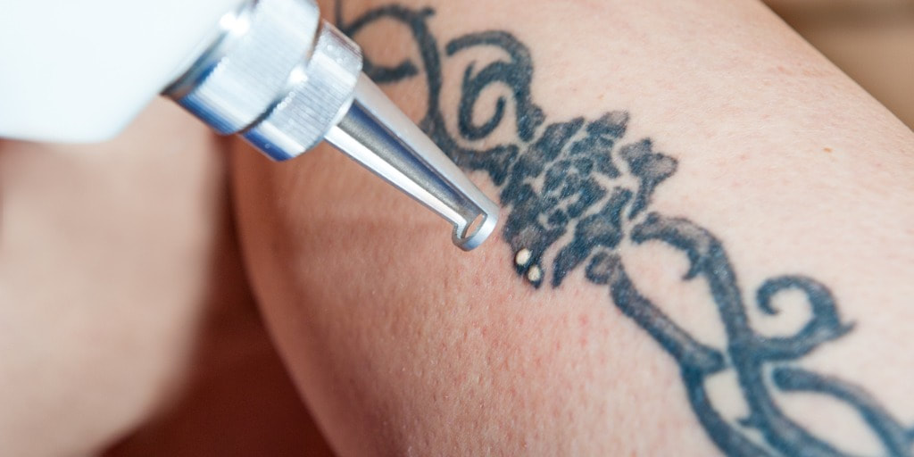 Tattoo Removal - Tempe Laser Center
